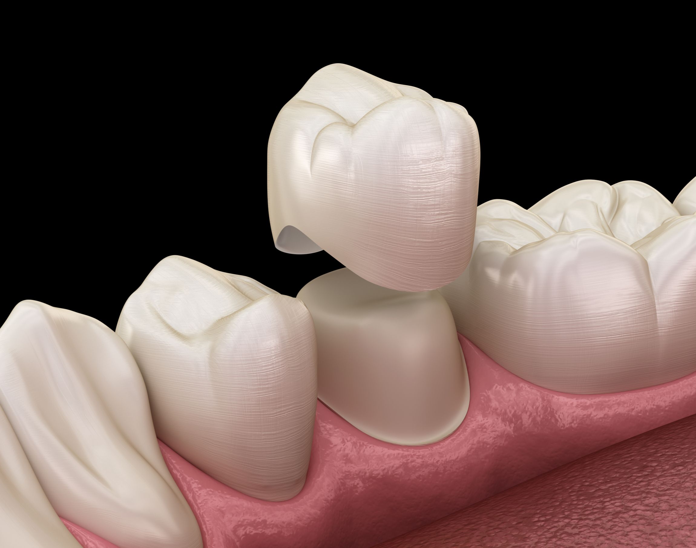 An illustration of a dental crown 
