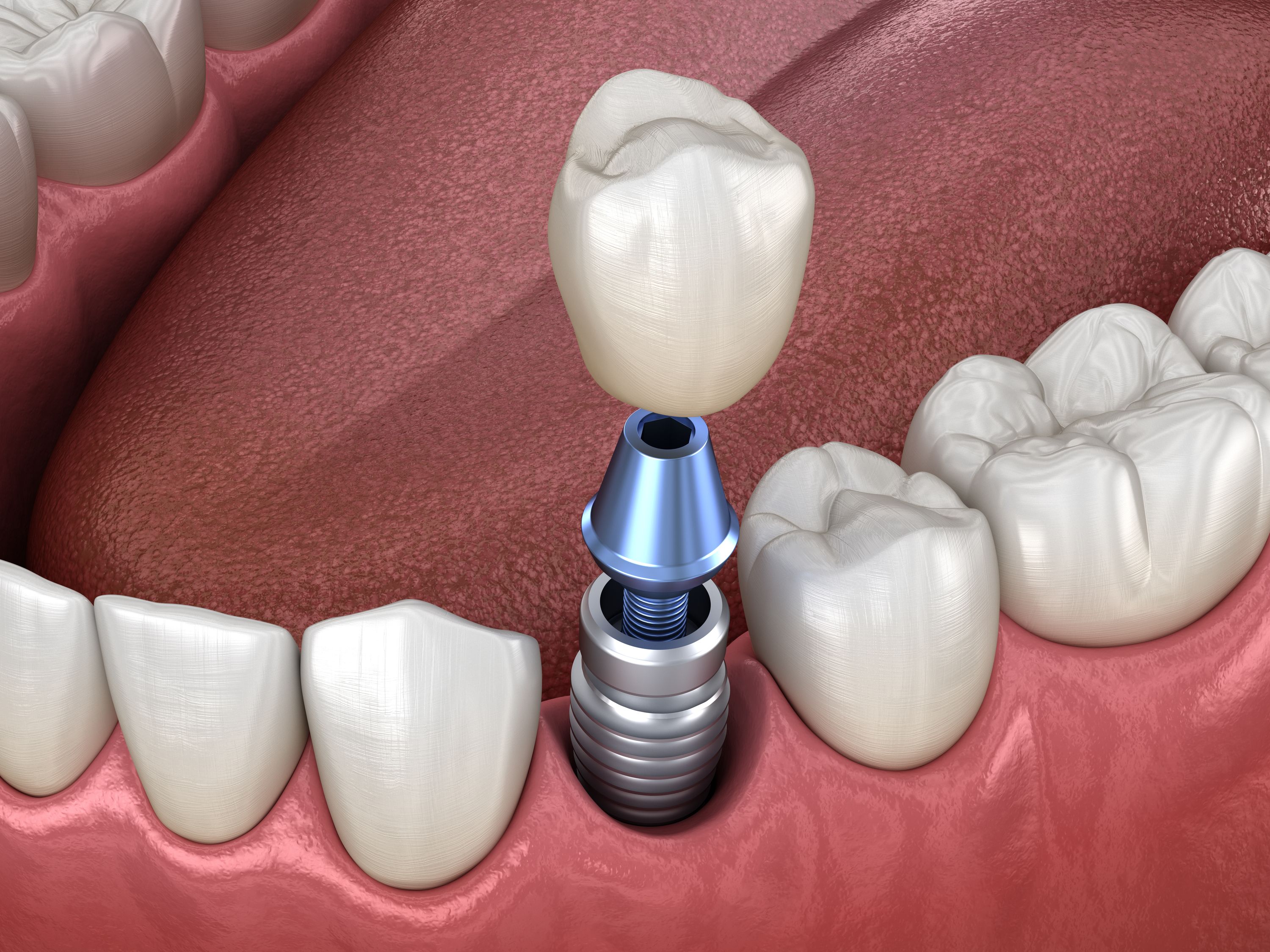 Dental Implant Surgery Recovery: Lake Jackson, TX