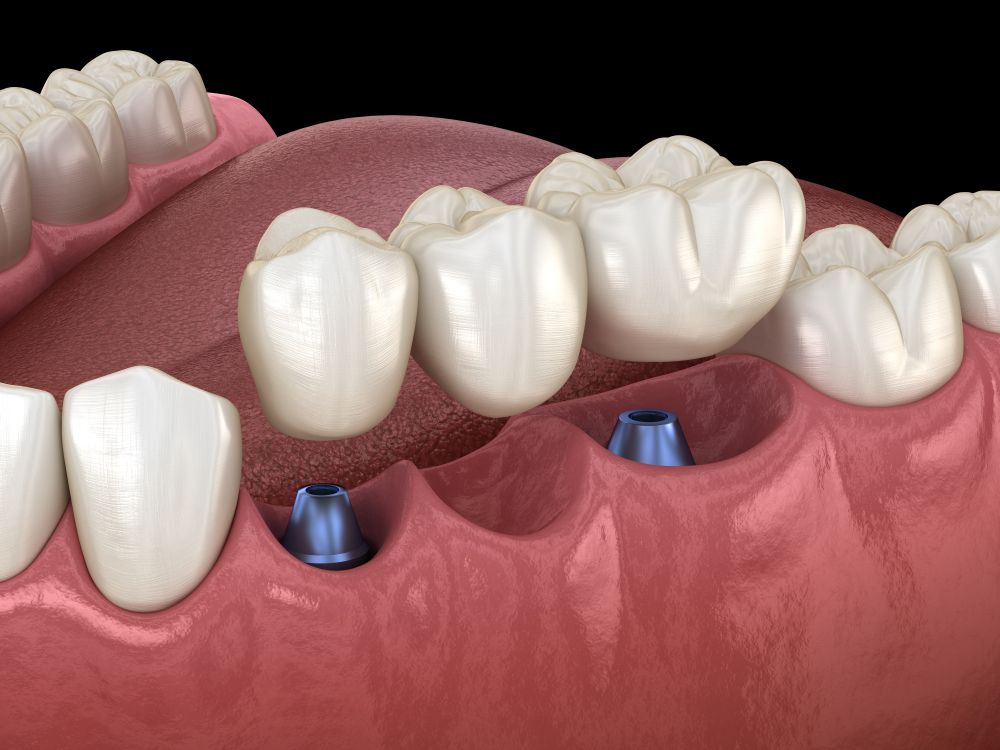 Dental implants