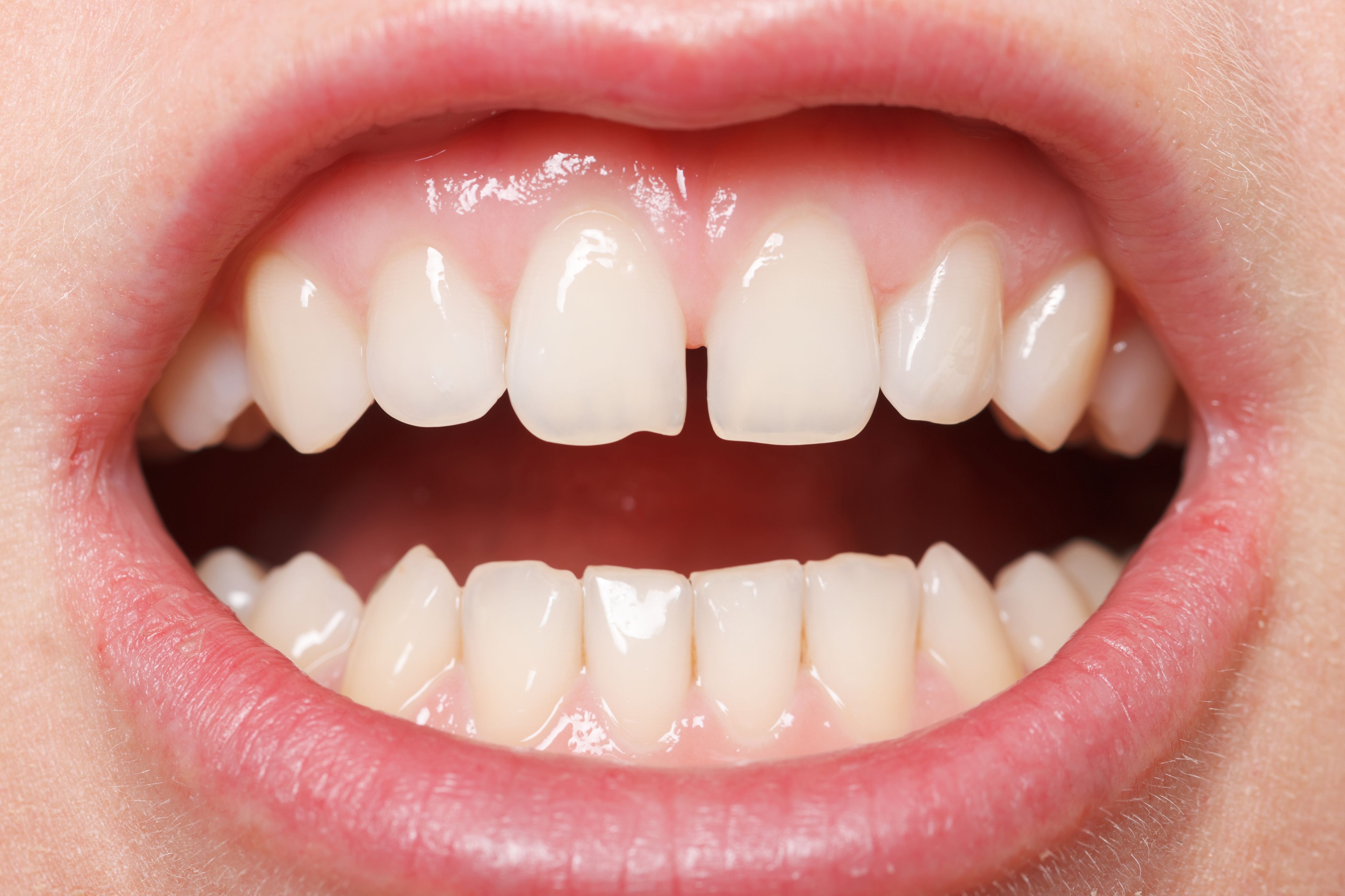 gapped tooth tooth gap invisalign