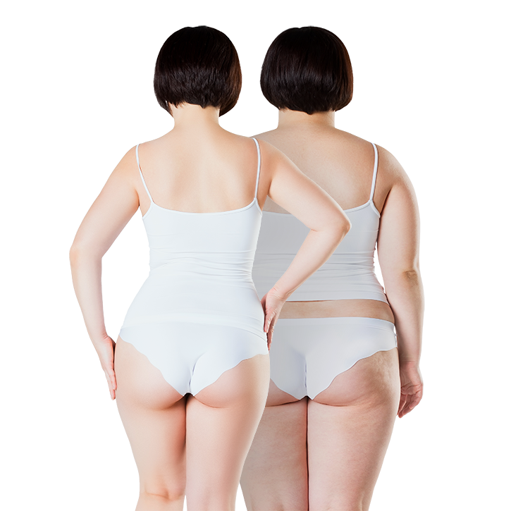 Weight Loss Surgery Vs Liposuction, Weight Loss Surgery