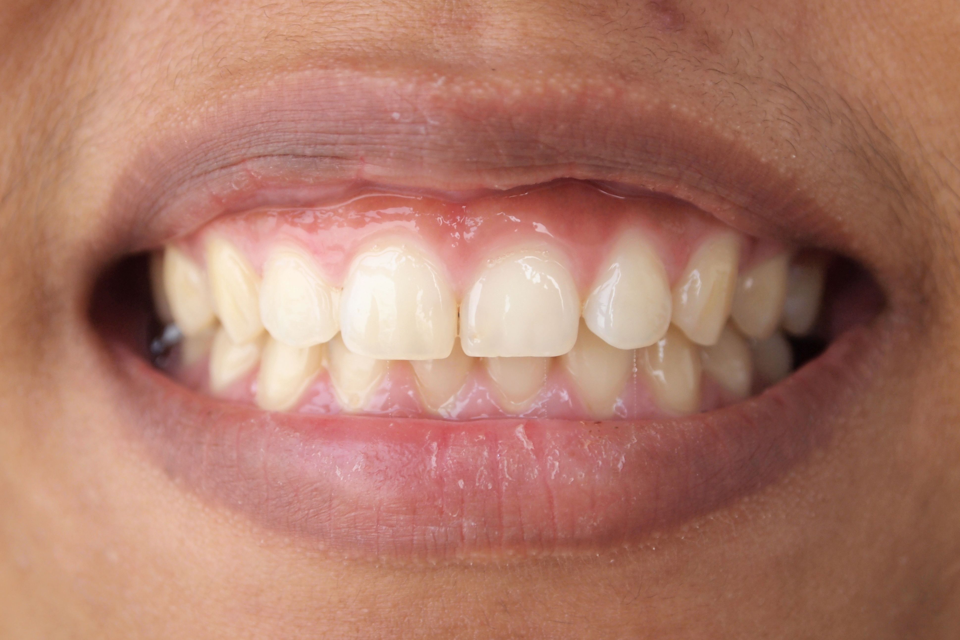 receding gums surgery before and after