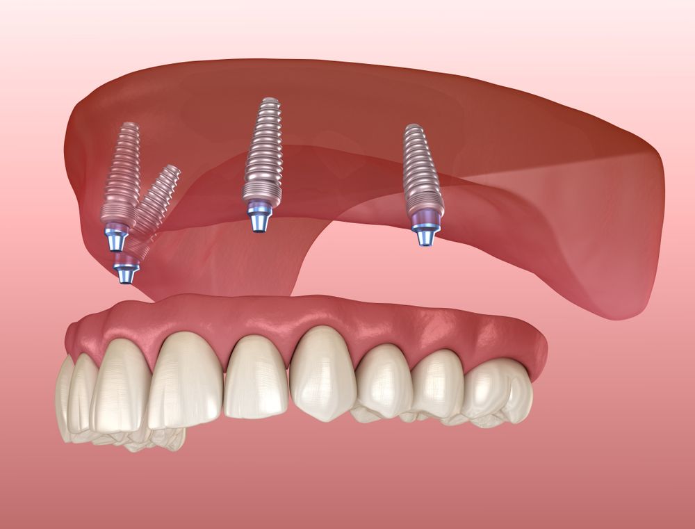 Teeth Whitening London