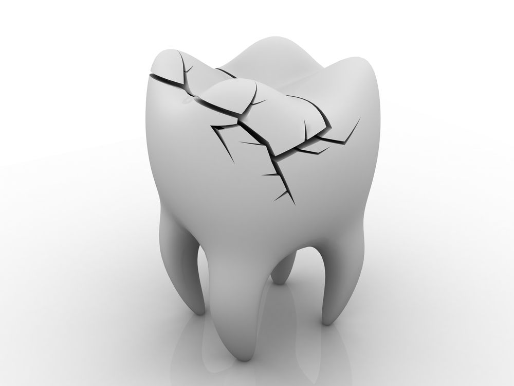illustration of a cracked tooth