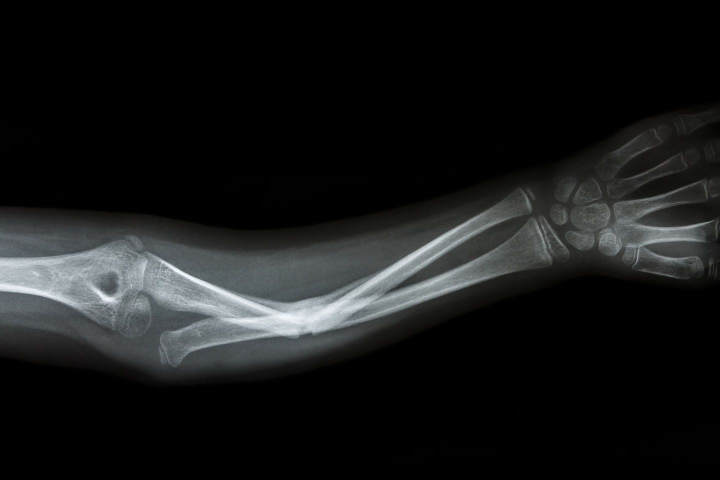 xray of broken arm