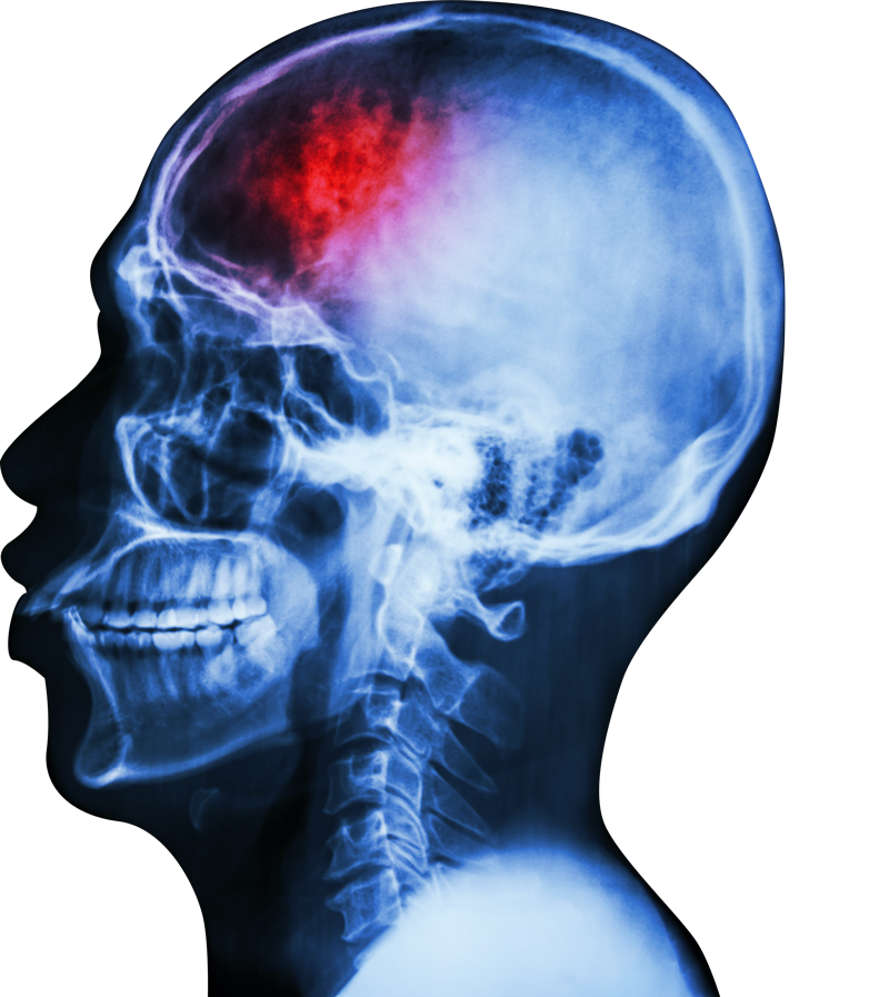 scan showing a red area in the front of the brain
