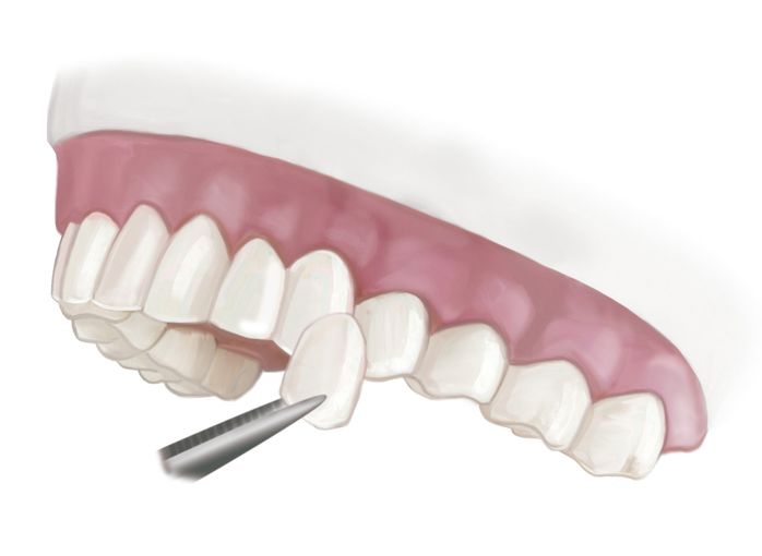Drawing of an upper row of teeth as a porcelain veneer is placed over a tooth