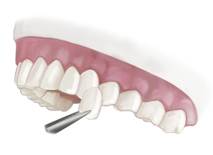 teeth veneers procedure