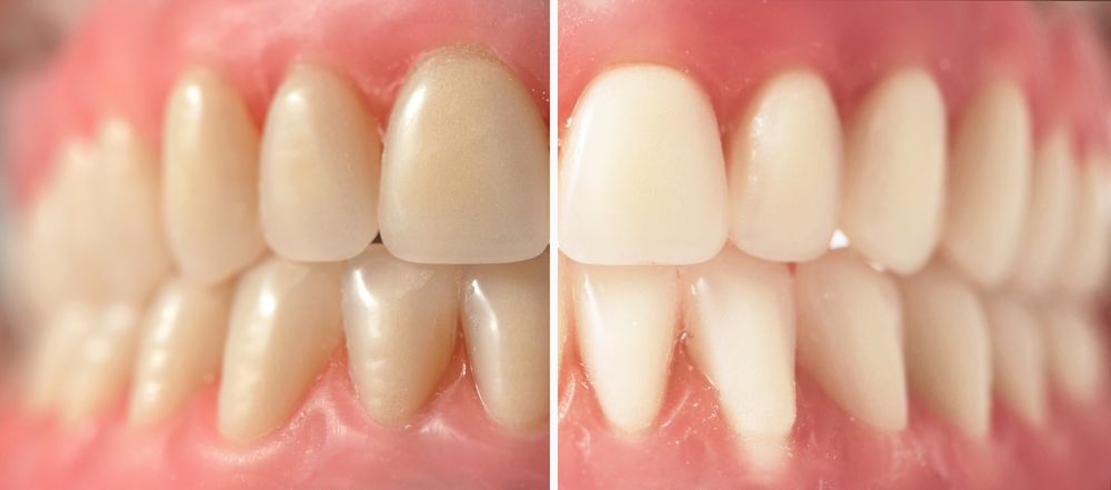 Teeth before and after teeth whitening