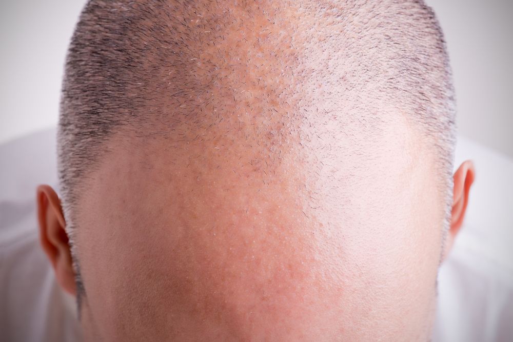 Hair Transplant Journey Hair Transplant After 3 Months  Results