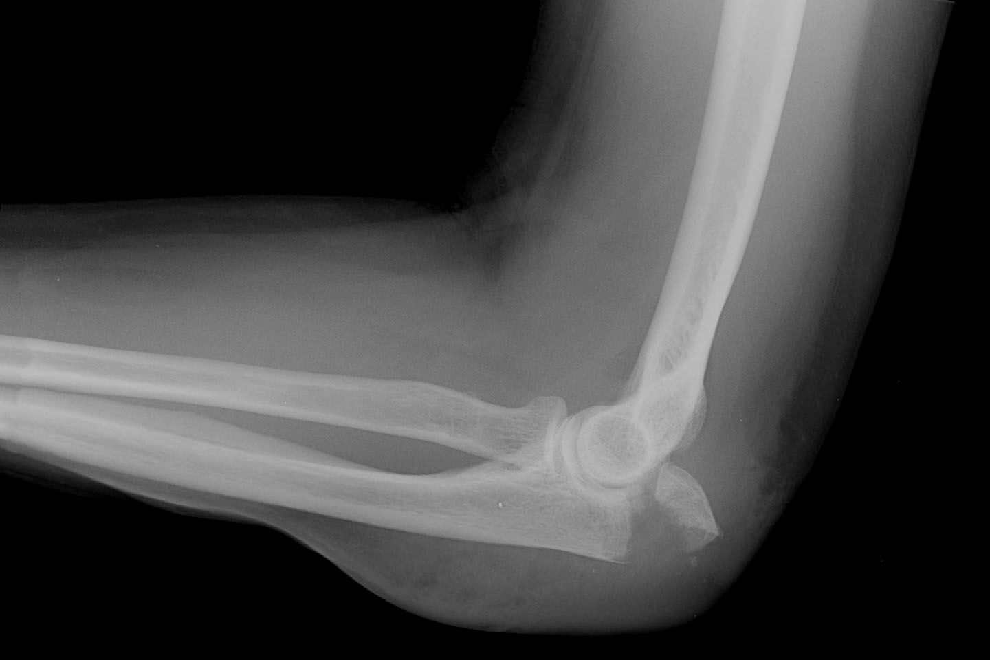 elbow x ray fracture