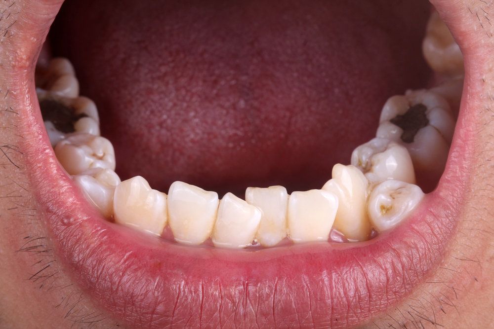 Extra Teeth Growing in Adults  : Causes and Solutions