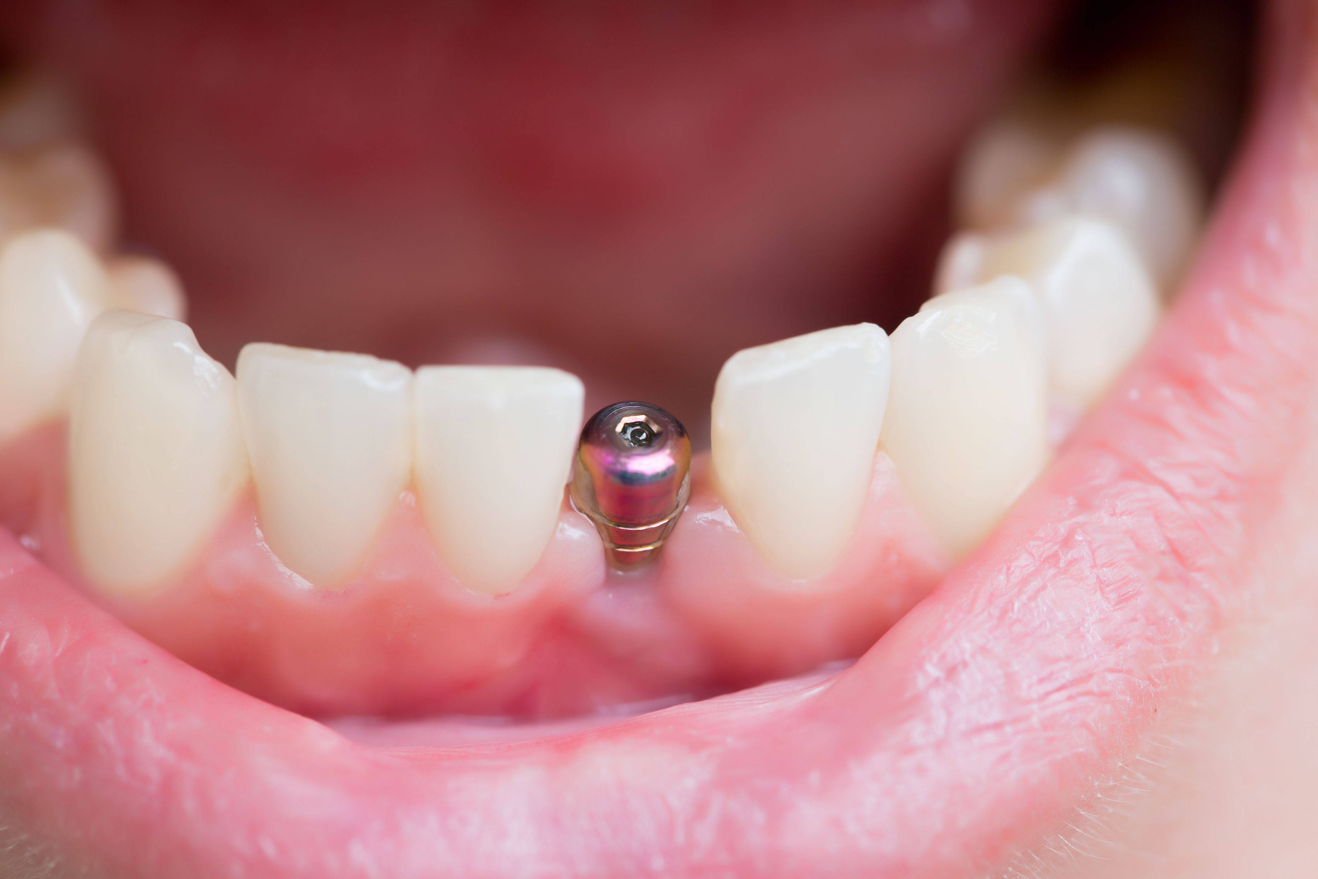 dental-implant-surgery-recovery-minerva-oh