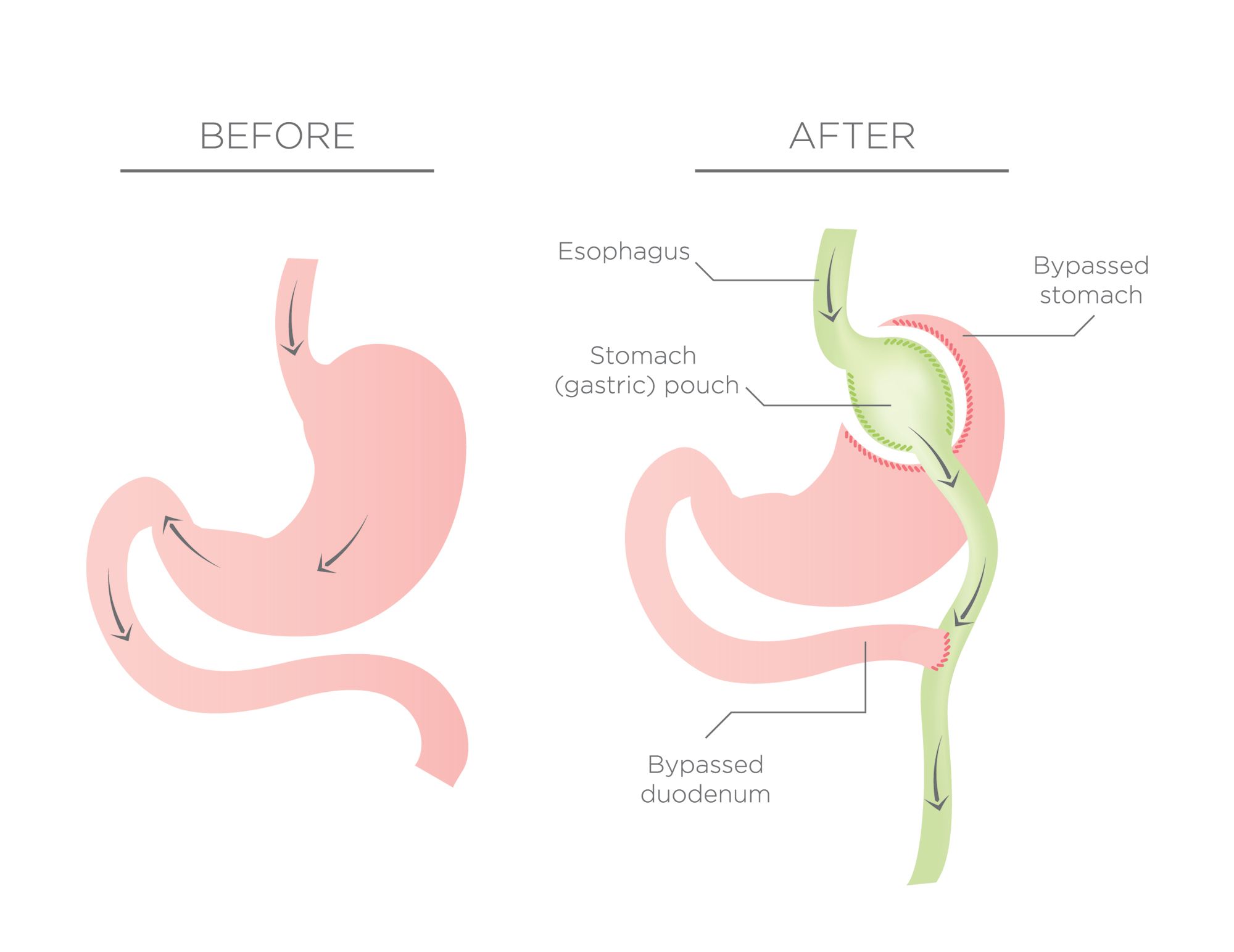 Types of weight loss surgery | Hospital Assist | Medibank