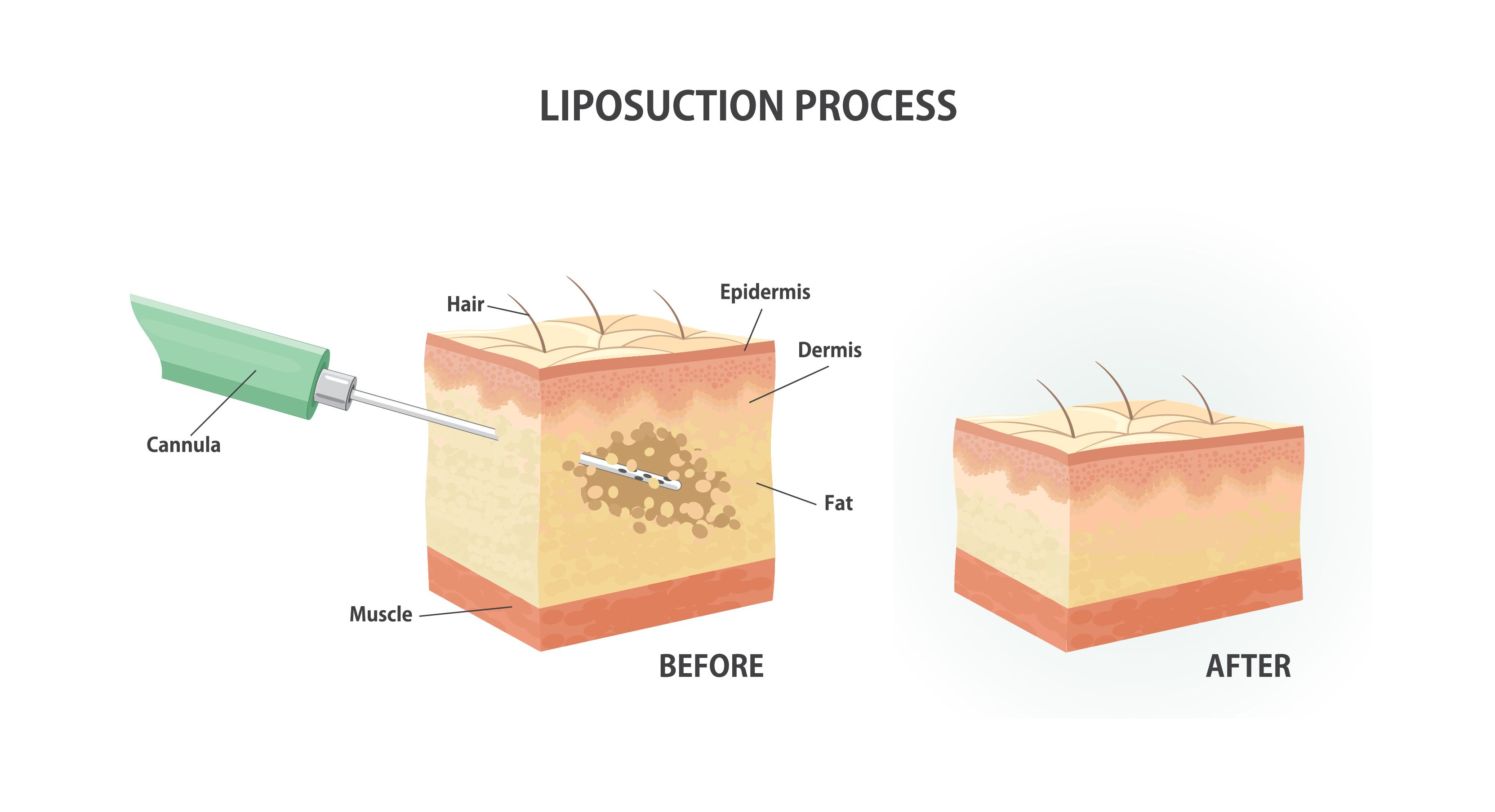 Austin Liposuction