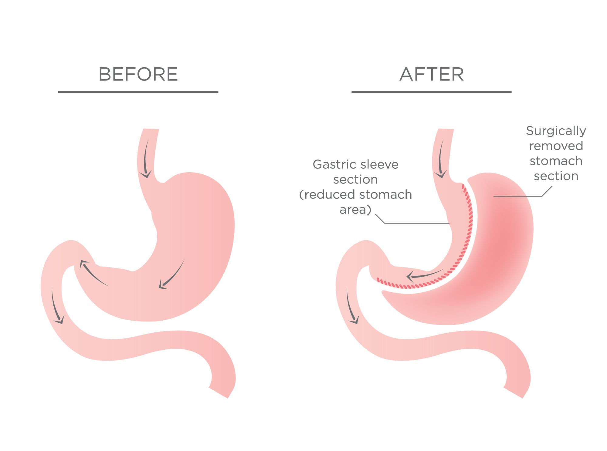 tijuana-bc-gastric-sleeve-side-effects-sleeve-gastrectomy-surgery