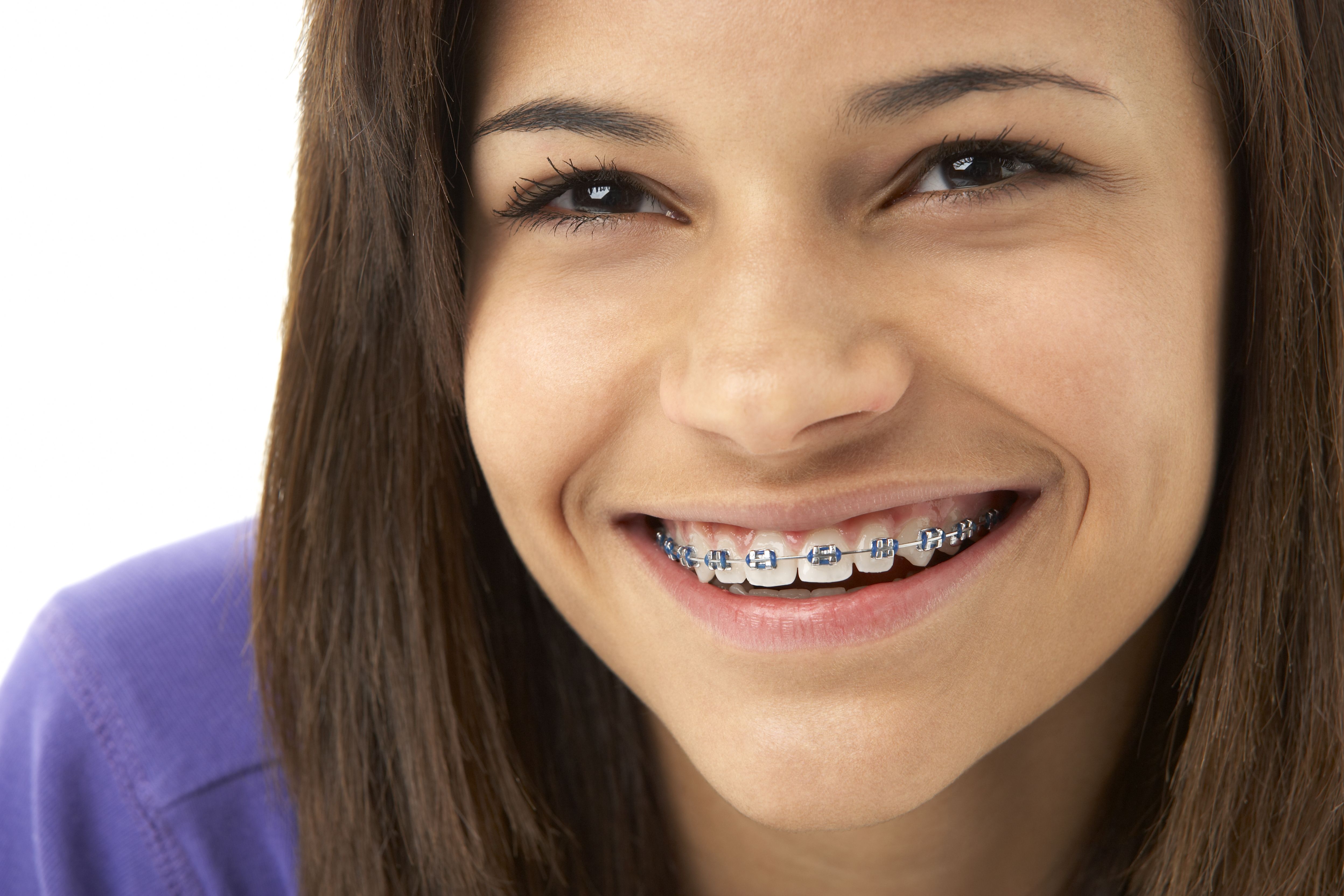 Braces For Overbite Montreal QC