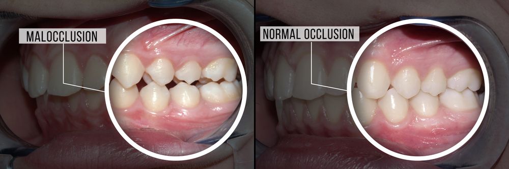 teeth with malocclusion vs. teeth with normal occlusion