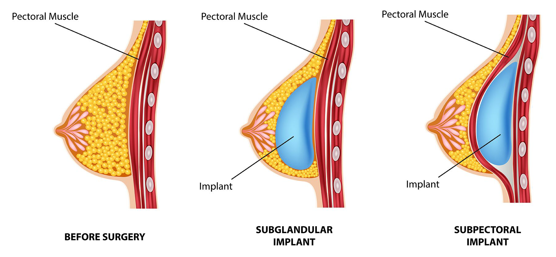 Illustration of breast implant placement