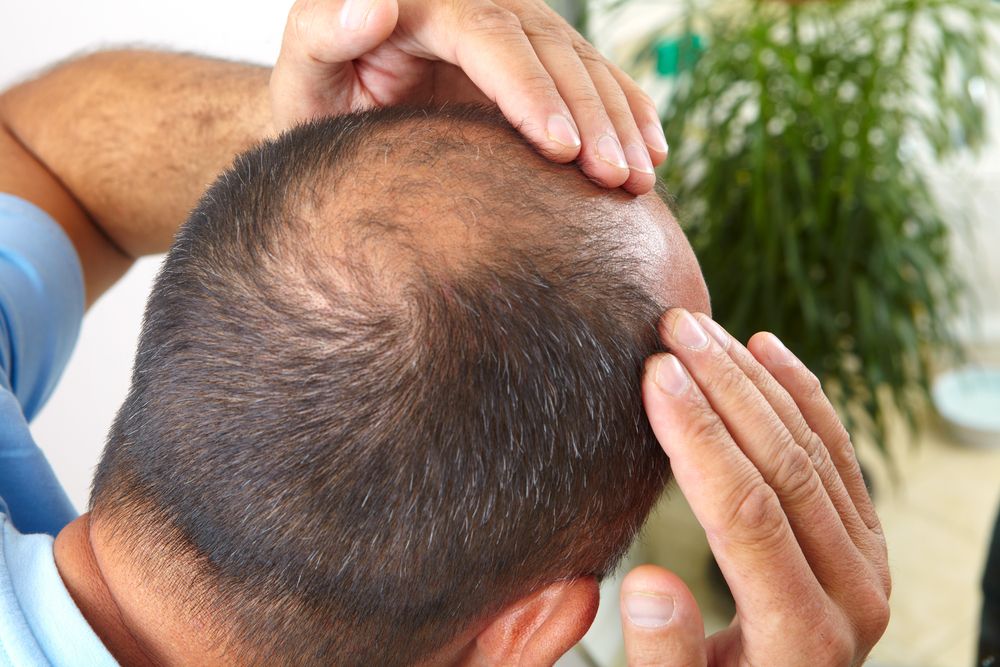 Hair Transplantation and the Effect of Scalp Tissue