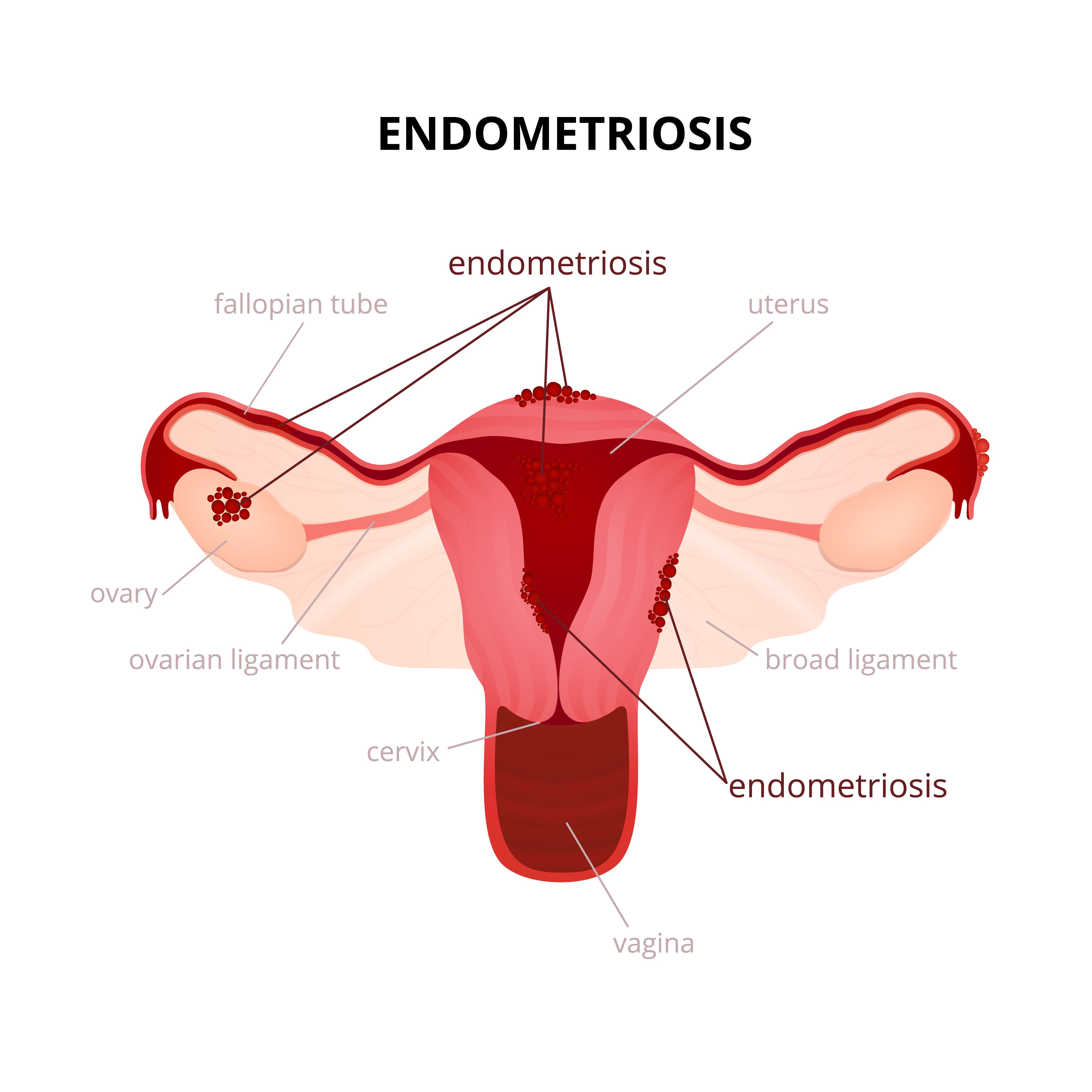 Can Endometriosis Cause Lesions