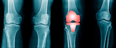 X-rays of knees and a knee replacement