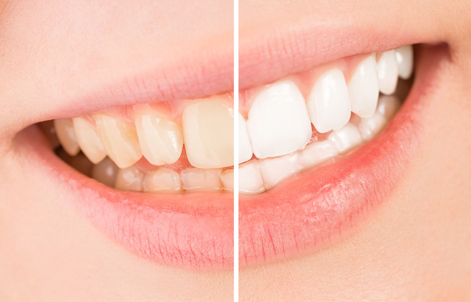 Teeth before and after whitening treatment