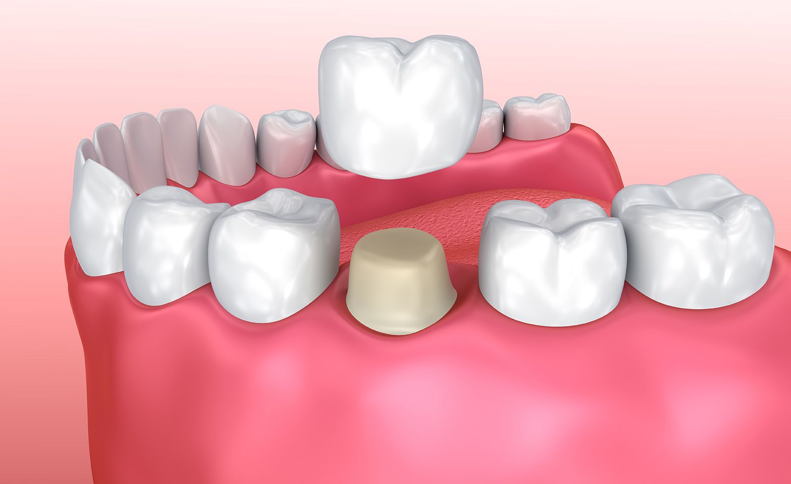 A porcelain dental crown capping a tooth