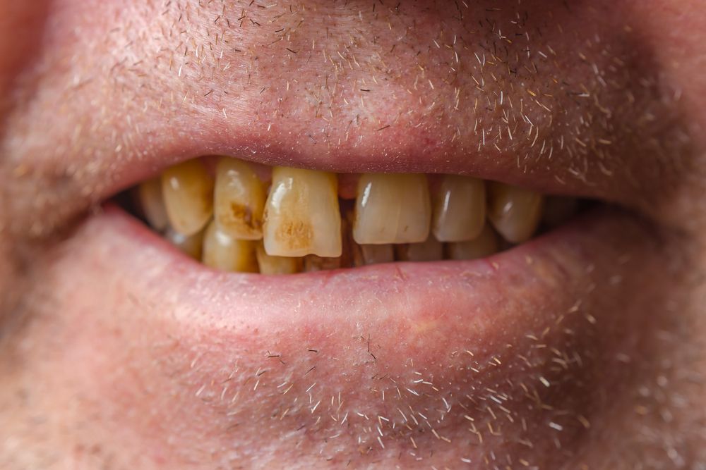 Severely discolored and worn teeth