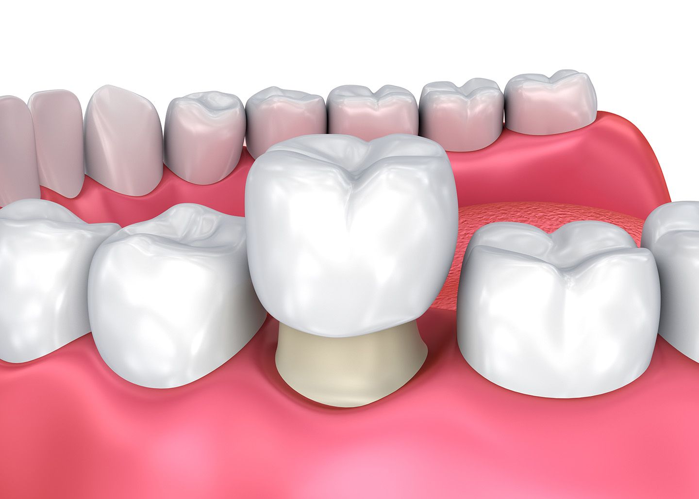 dental crowns