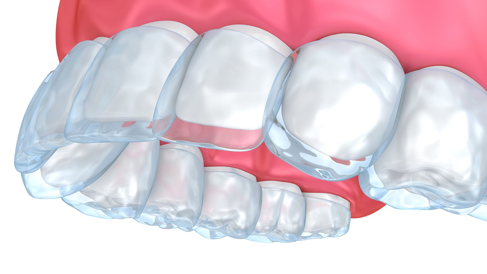 DT News - US - Spotlight on Invisalign: Pros and cons of treatment planning  with clear aligners