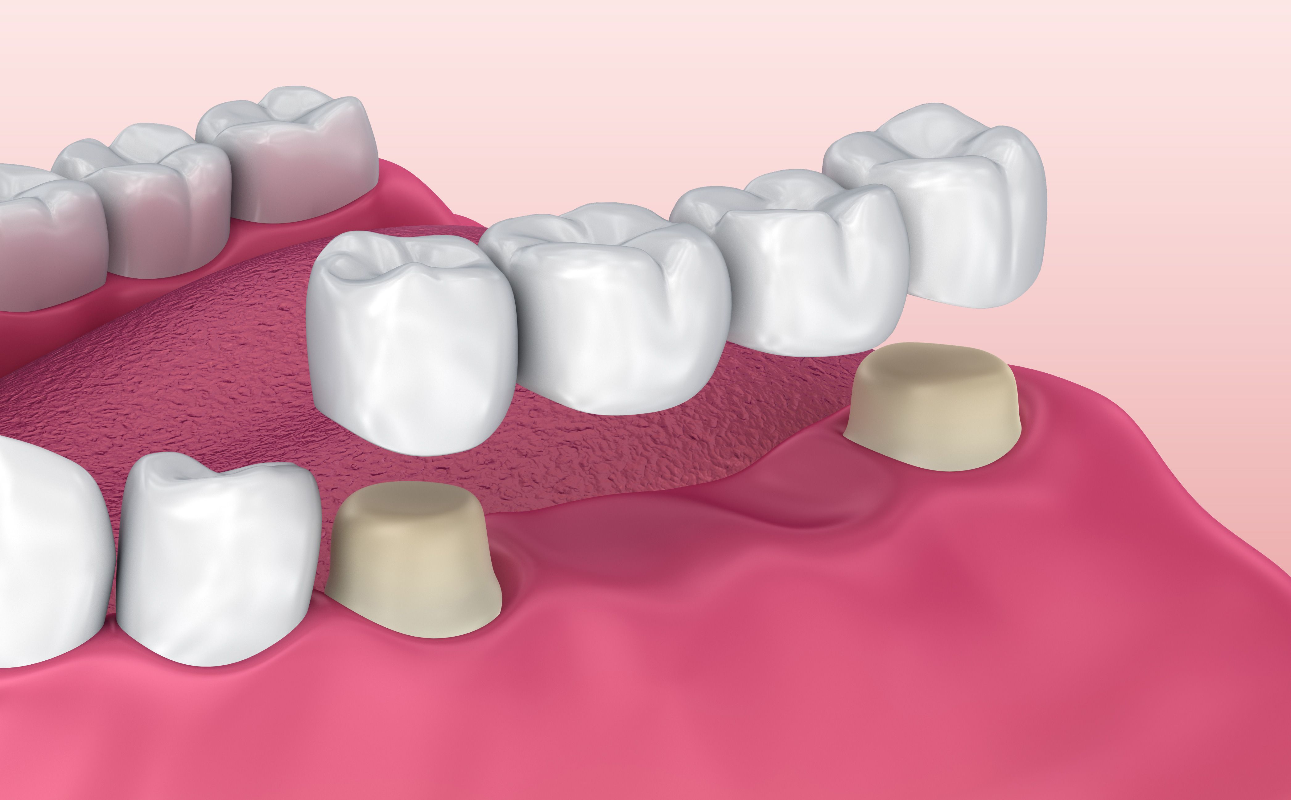 Digital illustration of dental bridge being placed