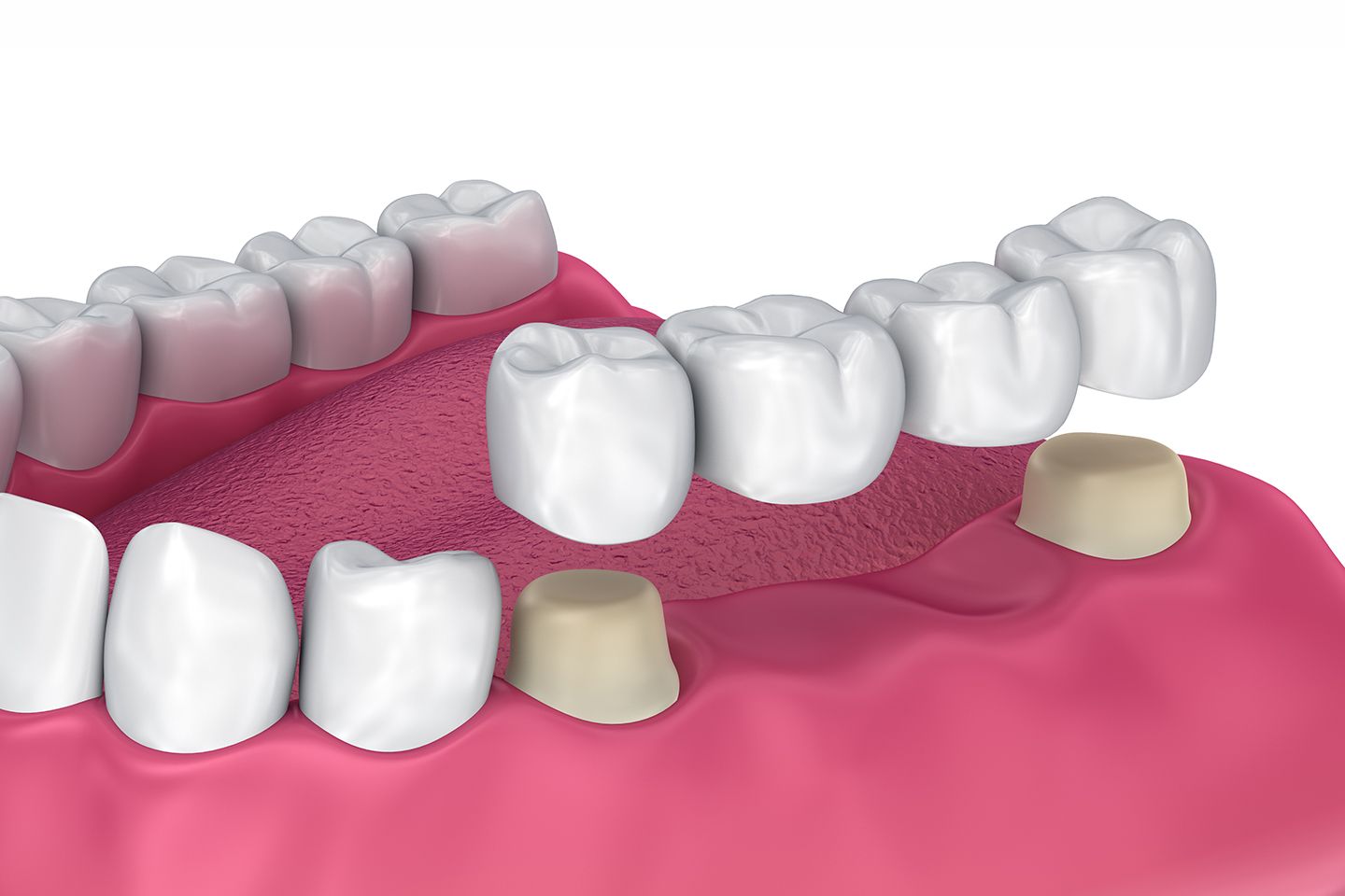 hyperdontia fake