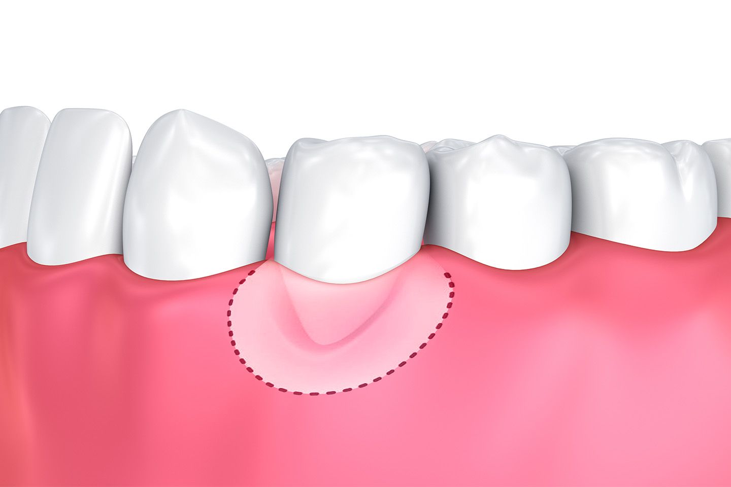 Gum Graft - Rockville, MD - Victor R. Siegel, DDS