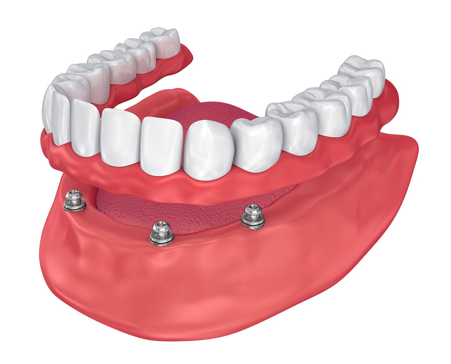 All-on-4 Implant Cons / Disadvantages - Ridgewood, Bergen County NJ