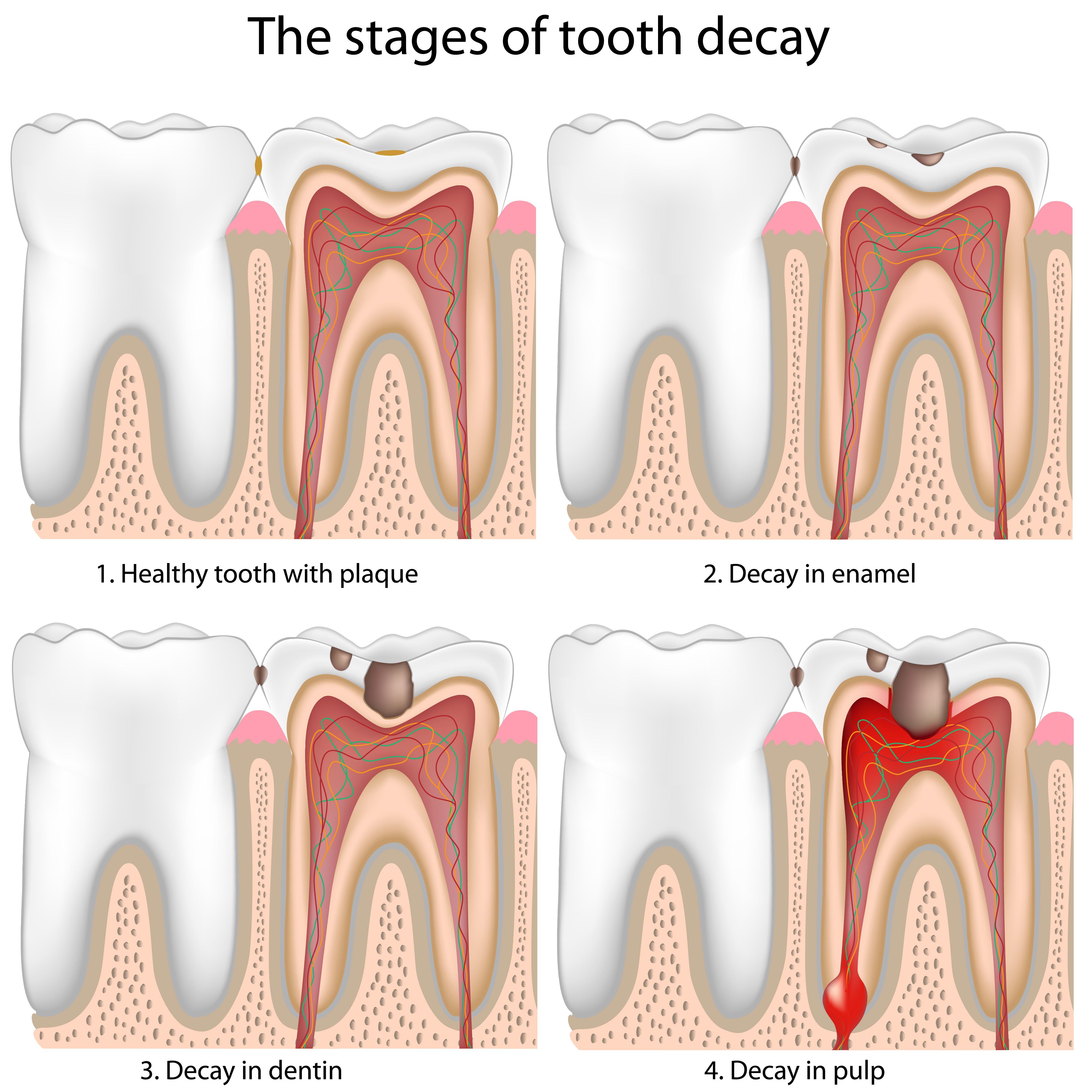 Stages of tooth decay