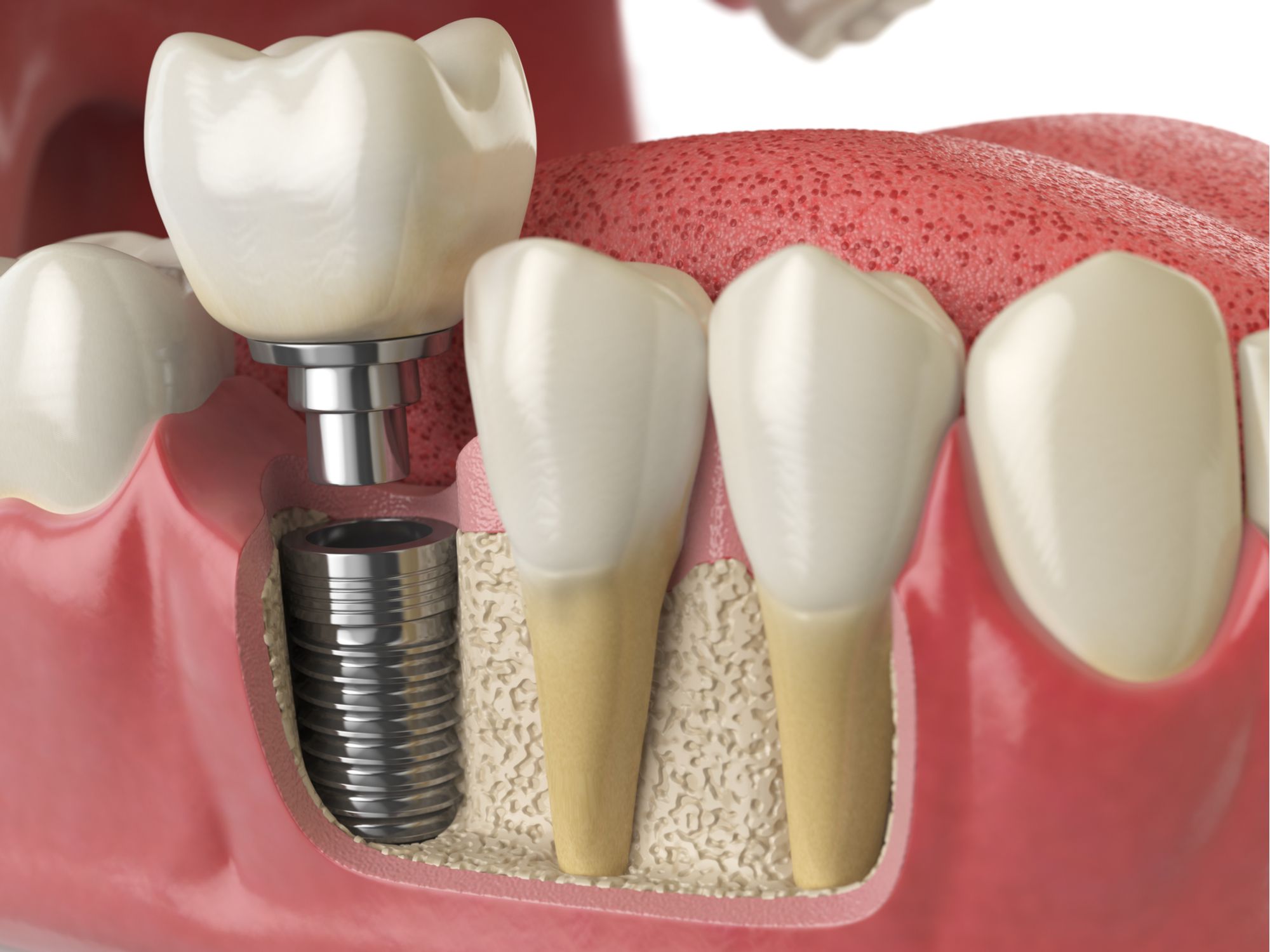 history-of-dental-bridges-and-dentures-boston-ma