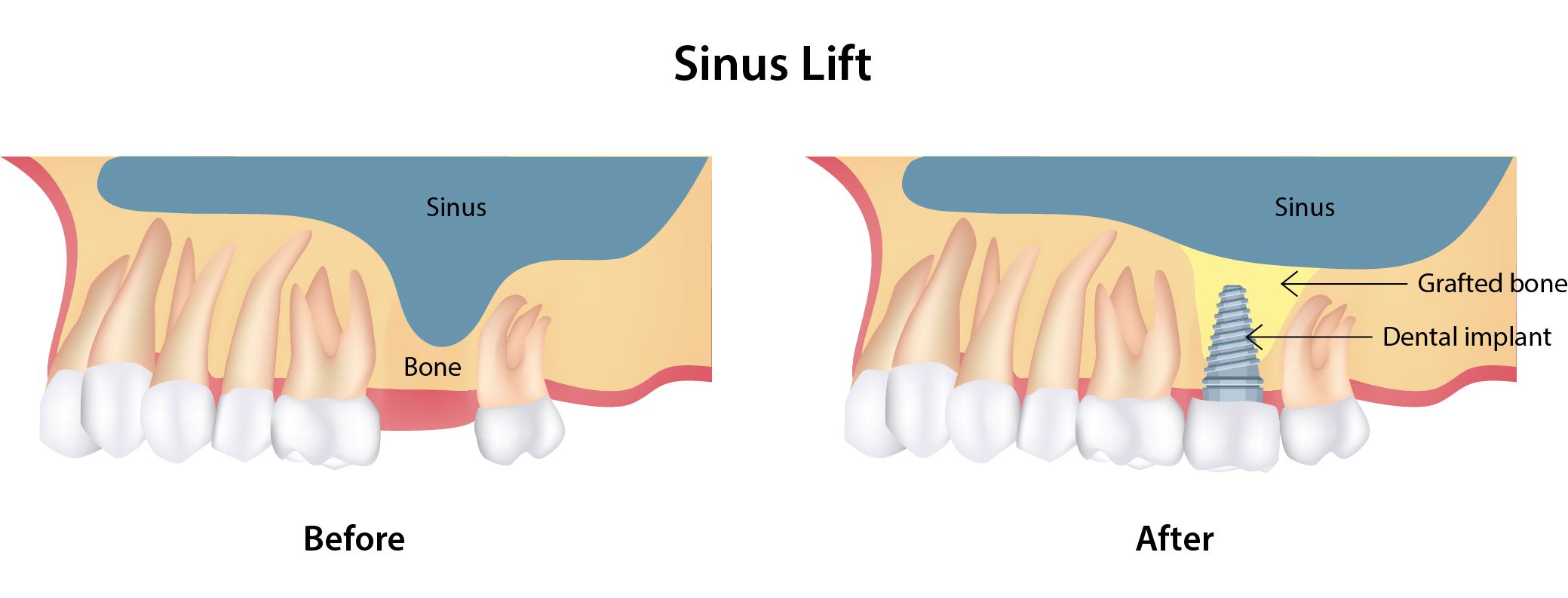 Sinus Lift Logan Ut Garland Ut Gregory E Anderson Pc