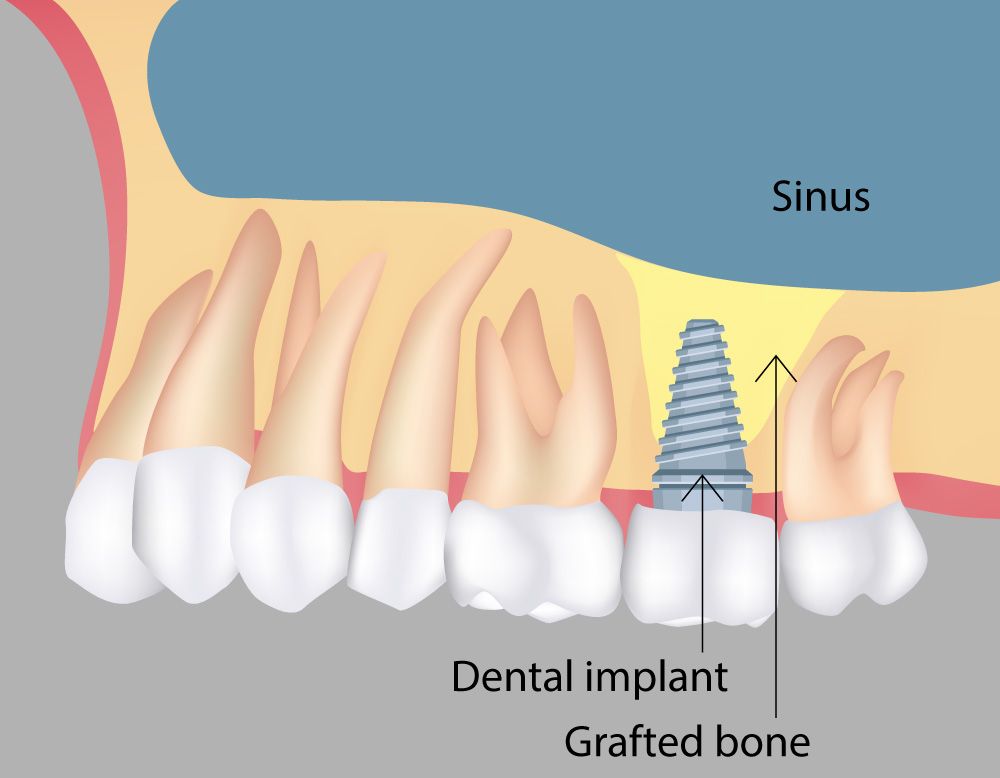 sinus-lift-bone-grafting-surgery-nashville-tn-upper-arch-dental-implants