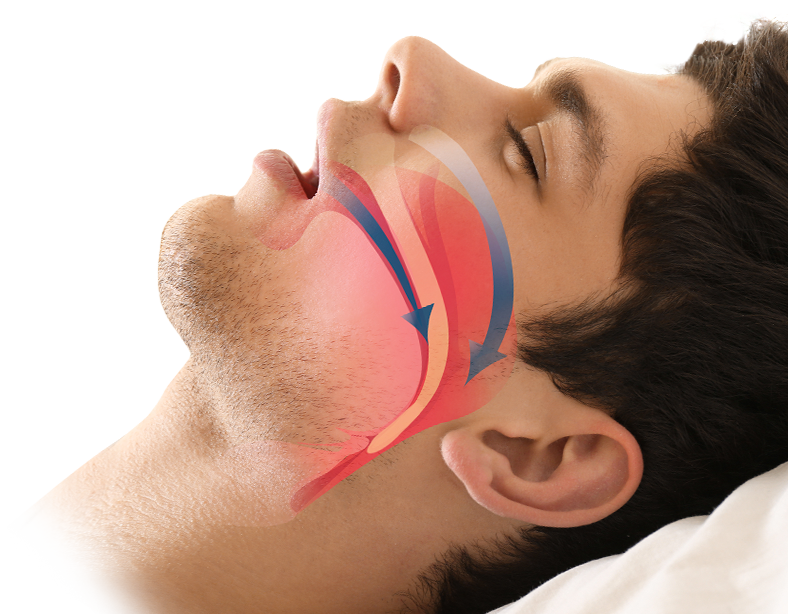 What Kind of Sleep Apnea Do You Have? - Houston Sleep Solutions