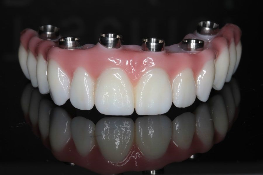 Teeth Tomorrow® - Staten Island, NY – Implant-Supported Dental Bridges