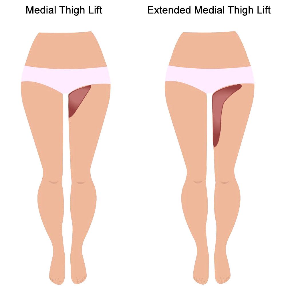 Short vertical scar medial thigh lift