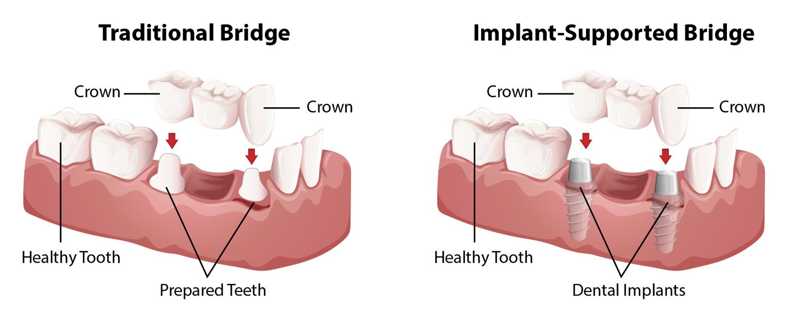 Types of dental bridges